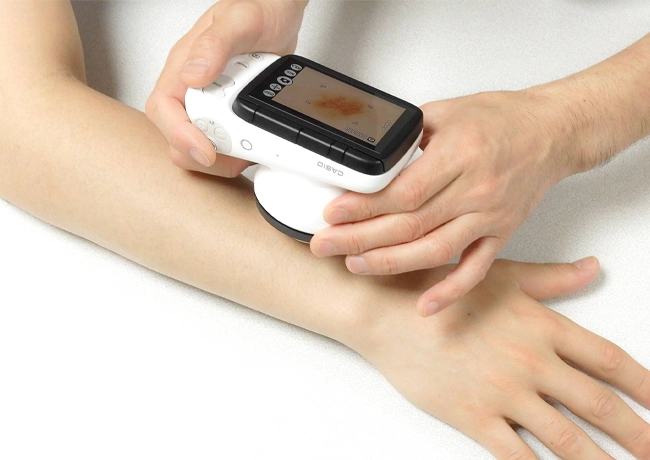 A doctor taking photos of a skin lesion on a Casio Derm Camera DZ-D100